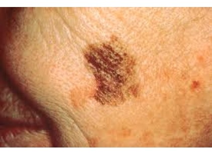 Kako da prepoznate rak kože?